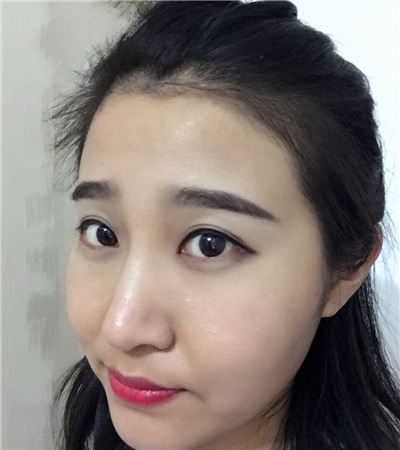 玻尿酸注射隆鼻前后對(duì)比果圖片分享，大同美神賈文醫(yī)生做的~