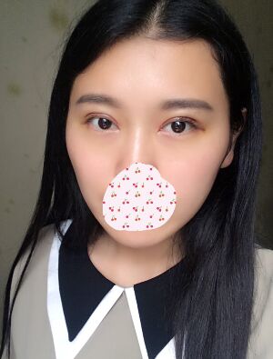 雙眼皮失敗修復(fù)手術(shù)恢復(fù)超自然，看起來一點(diǎn)都不假
