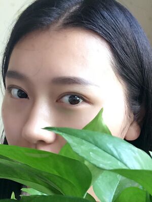 雙眼皮失敗修復(fù)手術(shù)恢復(fù)超自然，看起來一點(diǎn)都不假