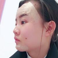 自體脂肪面部填充恢復(fù)過程分享，填充價格12000元