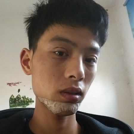 內(nèi)切去眼袋+切開割雙眼皮恢復(fù)過程和前后對比果圖片分享哦~