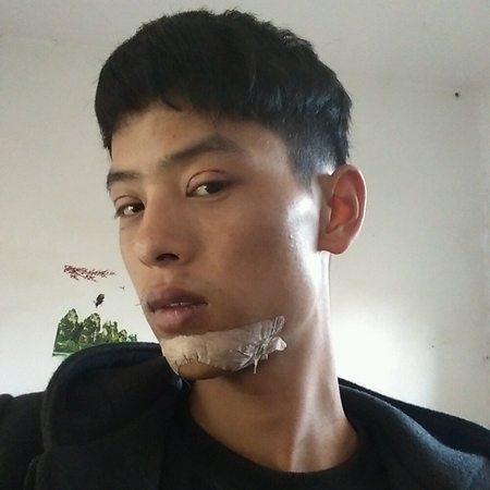 內(nèi)切去眼袋+切開割雙眼皮恢復(fù)過程和前后對比果圖片分享哦~