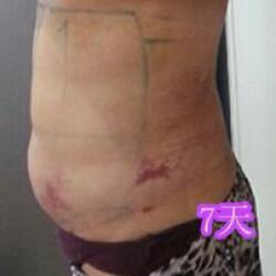 肚子減肥的方法就是吸脂減肥瘦腰腹了，親身經(jīng)歷分享