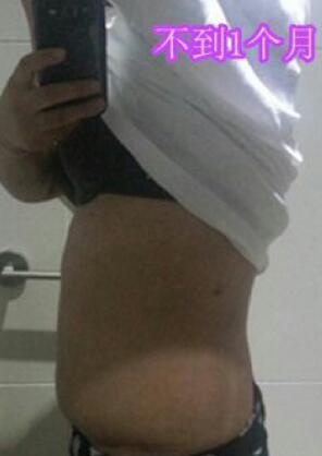 吸脂減肥瘦腰腹術(shù)后近一個月恢復果