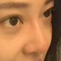 為什么大家覺得隆鼻恐怖，我就做了玻尿酸隆鼻，過程經(jīng)歷分享