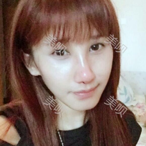 膨體隆鼻后我也有了像明星那樣的小翹鼻了