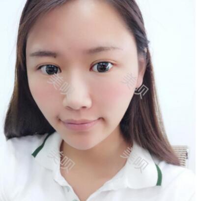 自體脂肪面部填充后臉上有膠原蛋白的感覺真爽