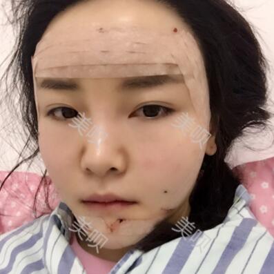 自體脂肪面部填充40天的恢復(fù)過程給大家做個參考