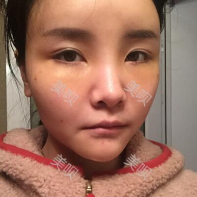 自體脂肪面部填充40天的恢復(fù)過程給大家做個參考