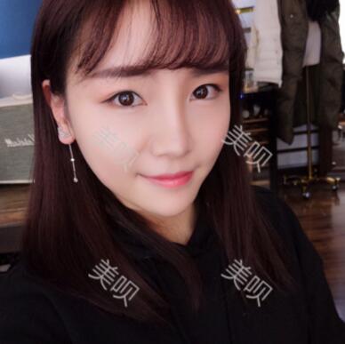 自體脂肪面部填充40天的恢復(fù)過程給大家做個參考