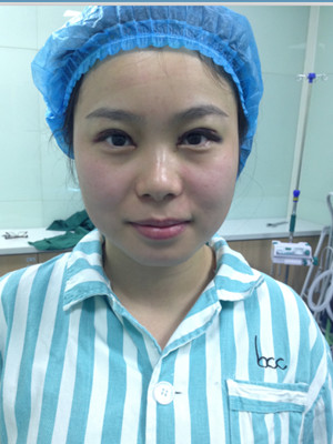 開內(nèi)眼角+雙眼皮手術(shù)后，我也變成大眼睛妹紙了