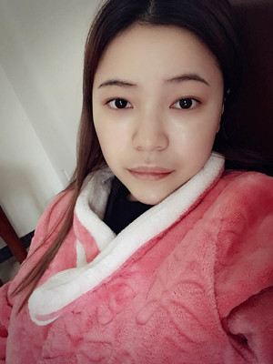 去年12月做的自體脂肪填充蘋果肌，大家來看看果怎么樣?