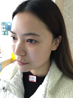 去年12月做的自體脂肪填充蘋果肌，大家來看看果怎么樣?