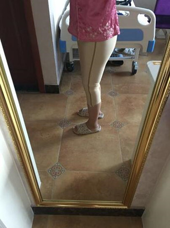 我的大腿吸脂真實果恢復(fù)對比案例圖