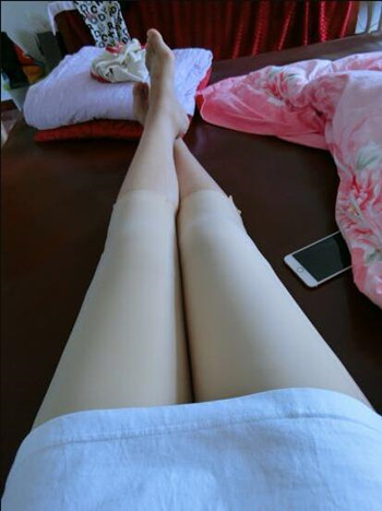 我的大腿吸脂真實果恢復(fù)對比案例圖