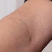 從小我就毛發(fā)旺盛，做了激光脫毛果圖分享給大家