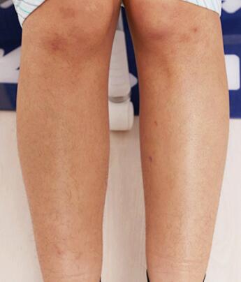 激光脫毛前腿部汗毛圖