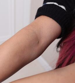 激光脫毛前手臂汗毛圖