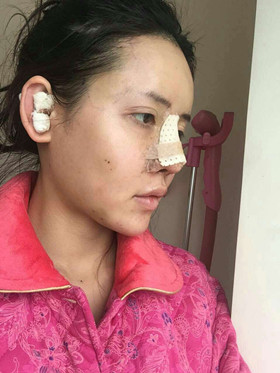 自體軟骨隆鼻+自體脂肪豐蘋果肌，成功逆襲成女神