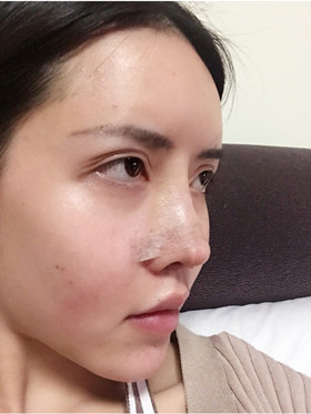 自體軟骨隆鼻+自體脂肪豐蘋果肌，成功逆襲成女神