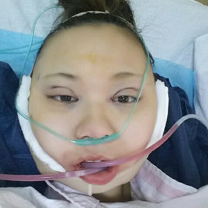 切開雙眼皮+磨下頜角，記錄了手術(shù)前后的過程，給大家分享一下