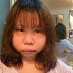 切開雙眼皮+磨下頜角，記錄了手術(shù)前后的過程，給大家分享一下