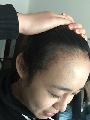 做了發(fā)際線種植手術(shù)，感覺(jué)還不錯(cuò)!