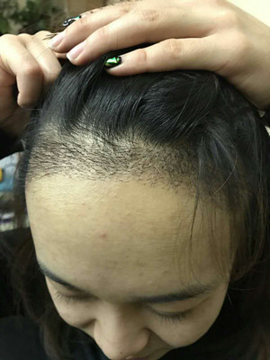 做了發(fā)際線種植手術(shù)，感覺(jué)還不錯(cuò)!