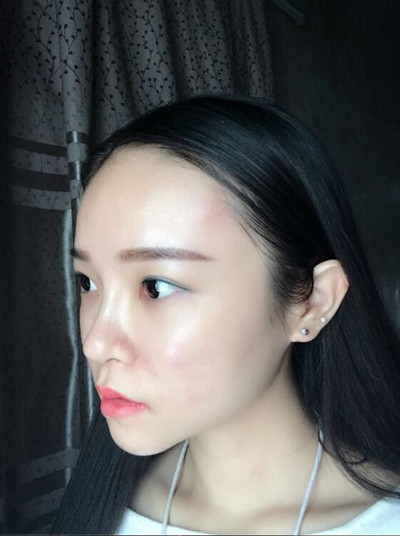 我的自體脂肪填充下巴+蘋果肌的恢復過程 自體脂肪真的是一個好東西