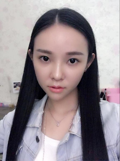 我的自體脂肪填充下巴+蘋果肌的恢復過程 自體脂肪真的是一個好東西