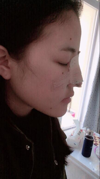 我的隆鼻整形恢復前后對果圖 一個字帥