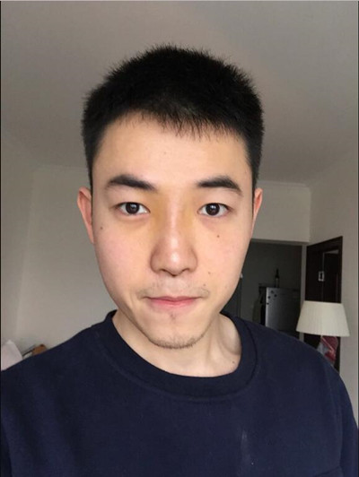 我的隆鼻整形案例恢復(fù)過程 大老爺們也有一個(gè)愛沒的心
