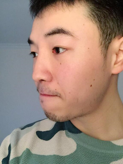 我的隆鼻整形案例恢復(fù)過程 大老爺們也有一個(gè)愛沒的心