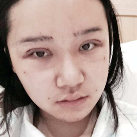 做切開雙眼皮三個月了，分享恢復(fù)過程和前后對比果照片~