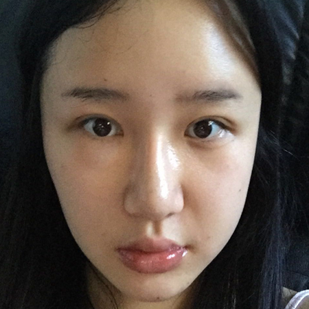 做切開雙眼皮三個月了，分享恢復(fù)過程和前后對比果照片~