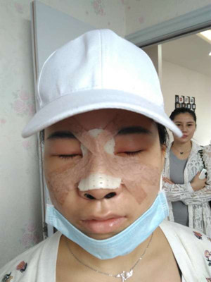 廣州廣美做的假體隆鼻，給大家分享一下手術(shù)前后過程以及對比照片