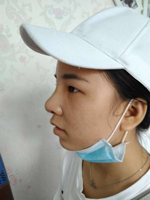 廣州廣美做的假體隆鼻，給大家分享一下手術(shù)前后過程以及對比照片