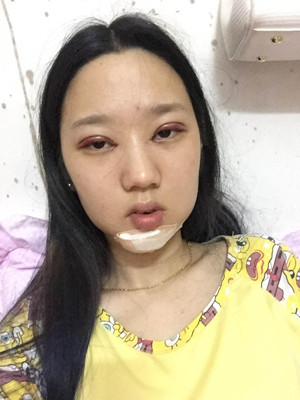 切開雙眼皮+假體隆下巴，我不再是典型的路人甲