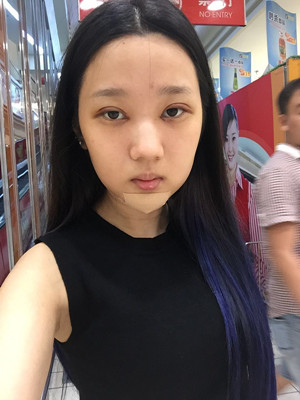 切開雙眼皮+假體隆下巴，我不再是典型的路人甲