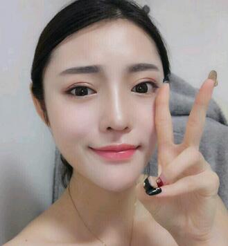 隆鼻整形1個(gè)月真實(shí)恢復(fù)期圖片