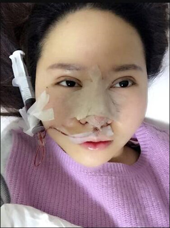 大鼻子就得做隆鼻整形手術(shù)改良 我的果就挺不錯(cuò)的