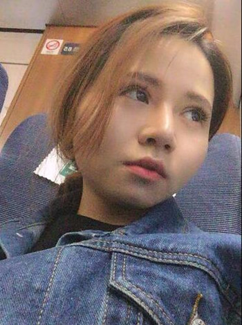 大鼻子就得做隆鼻整形手術(shù)改良 我的果就挺不錯(cuò)的