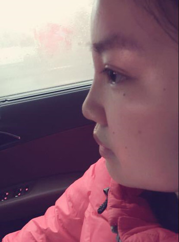 我的隆鼻整形恢復(fù)時的那些事