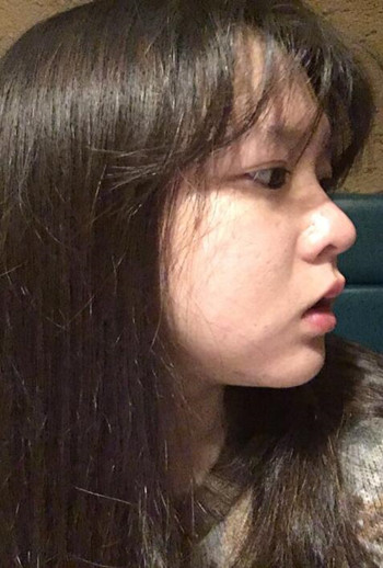 我的頰脂肪墊切除+假體墊下巴整形恢復(fù)果心情日記