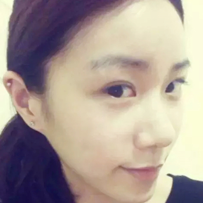 隆鼻整形+雙眼皮手術(shù)兩個月了，分享恢復(fù)前后對比果照片~