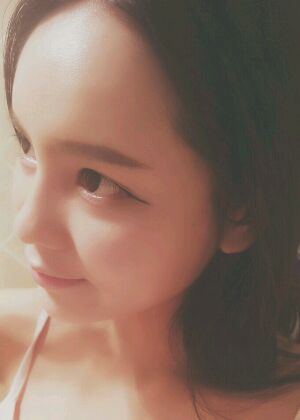 自體脂肪豐額頭+蘋果肌恢復(fù)兩個(gè)月照片分享