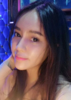 自體脂肪豐額頭+蘋果肌恢復(fù)兩個(gè)月照片分享