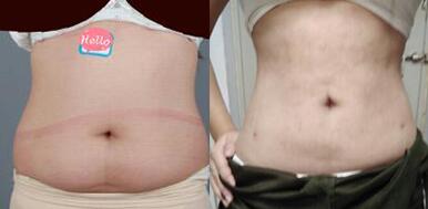 上海吸脂減肥價(jià)格是多少