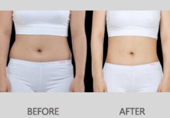 腰腹吸脂減肥對(duì)比圖