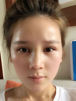 隆鼻和雙眼皮修復(fù)一起做的，現(xiàn)在氣質(zhì)提升好多